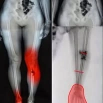 acupuncture, bone and xray