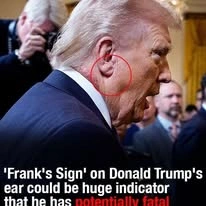 ‘Frank’s Sign’ on Trump’s ear could be huge indicator of potentially fatal health condition