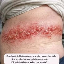 Mom has this blistering rash wrapping around her side