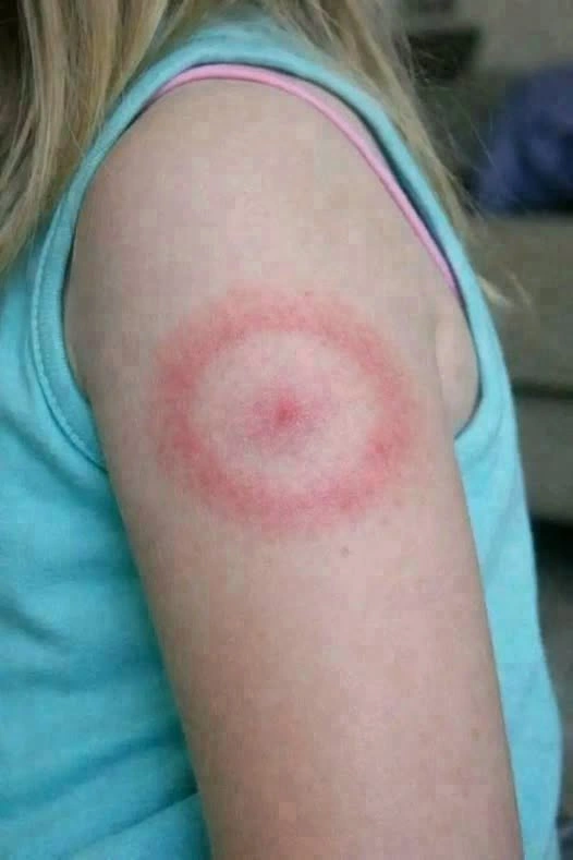 Assessing Circular Rashes in Children: A Calm Approach to Monitoring and Understanding Skin Changes