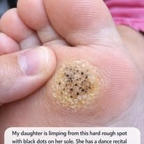 Painful Black-Dotted Spot on the Foot Leaves Parents Searching for a Fast Solution