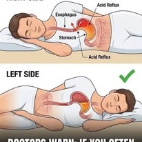 RIGHT SIDE Acid Reflux Esophagus Stomach AcidReflux Acid Reflux LEFT LEFTSIDE SIDE DOCTORS WARN: IF YOU