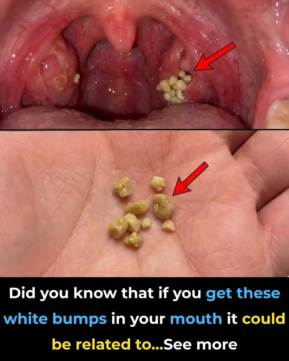 What Are Tonsil Stones Causes, Symptoms, and Simple Remedies - Story News